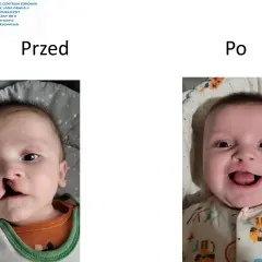 Dziecko z zajęczą wargą przed i po operacji. Uśmiechnięta buzia po korekcie.