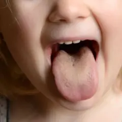 Dziecko pokazuje język, lekko żółty, jakby po stresie.