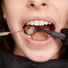 Dentysta bada zęby, sprawdzając, czy ósemki się leczy.
