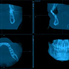Tomografia CBCT szczęki i żuchwy w przekrojach: osiowym, strzałkowym i wieńcowym, oraz wizualizacja 3D uzębienia.