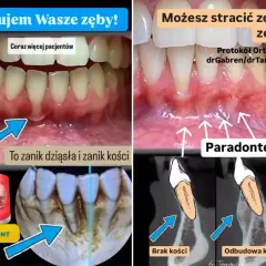 Przed i po: zanik dziąseł i kości (paradontoza) vs. odbudowa kości. Ratujemy zęby!