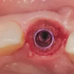 Implant dentystyczny w miejscu po wyrwaniu zęba. Po zabiegu może wystąpić gorączka po wyrwaniu zęba, ale implantacja jest bezpieczna.