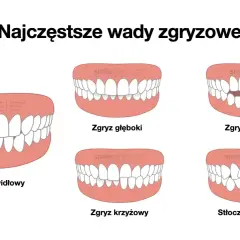 Ilustracja pokazuje różne wady zgryzu, w tym zgryz krzyżowy, gdzie zęby nie są idealnie dopasowane.