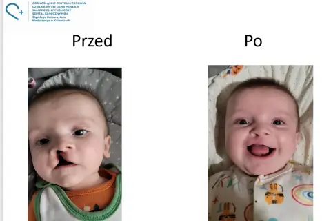 Dziecko z zajęczą wargą przed i po operacji. Uśmiechnięta buzia po korekcie.