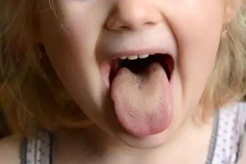Dziecko pokazuje język, lekko żółty, jakby po stresie.