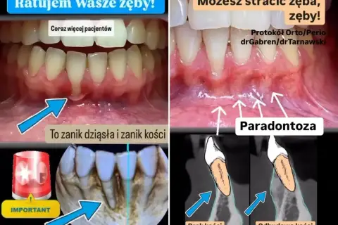 Zanikanie dziąseł i kości to paradontoza. Poznaj cenę leczenia recesji dziąseł i ratuj swoje zęby!