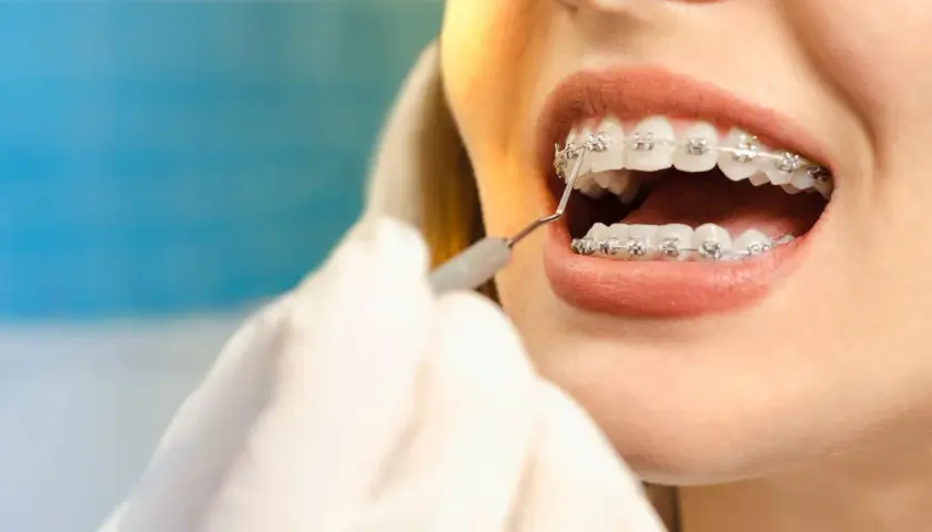 Ile kosztuje aparat na dolne zęby? Poznaj ukryte koszty leczenia