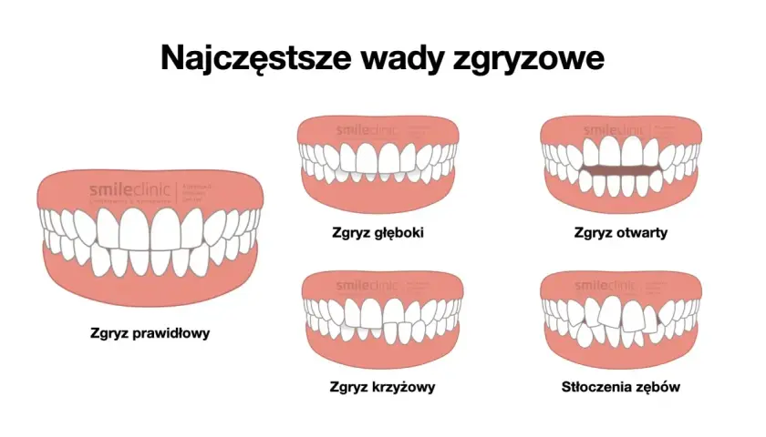 Ilustracja pokazuje różne rodzaje wad zgryzu: prawidłowy, głęboki, otwarty, krzyżowy i stłoczenia zębów.