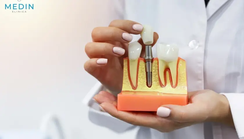 Model szczęki z implantem i koroną. Pokazuje, jak wygląda sinus lift otwarty, przygotowujący do wszczepienia implantu.