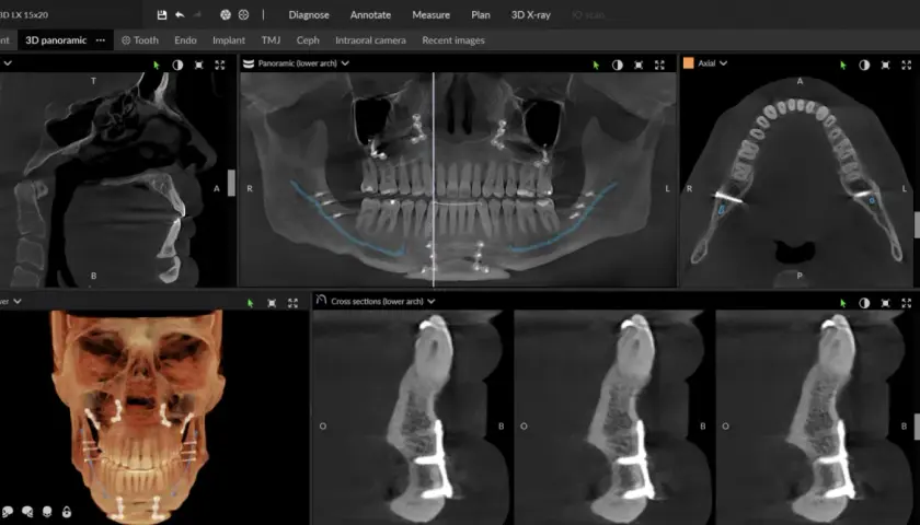 CBCT co to? Obraz przedstawia skany 3D szczęki i żuchwy z implantami, pokazujące szczegółową anatomię kości i zębów.