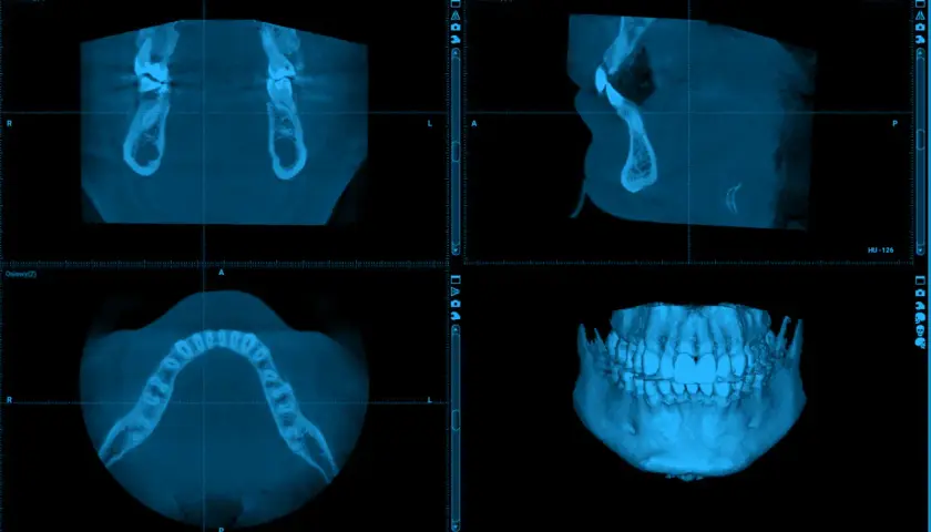 Tomografia CBCT szczęki i żuchwy w przekrojach: osiowym, strzałkowym i wieńcowym, oraz wizualizacja 3D uzębienia.
