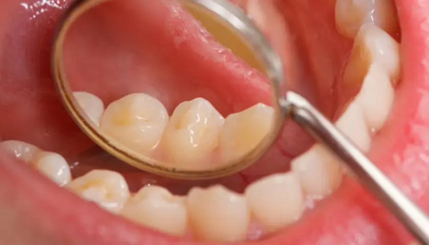 Widok jamy ustnej z lusterkiem dentystycznym. Na zębach widoczne są żółtawe przebarwienia, które mogą być początkiem próchnicy lub osadu.