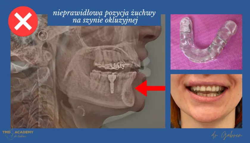 Rentgen żuchwy pokazuje nieprawidłową pozycję na szynie okluzyjnej. Szynoterapia pomaga poprawić zgryz.