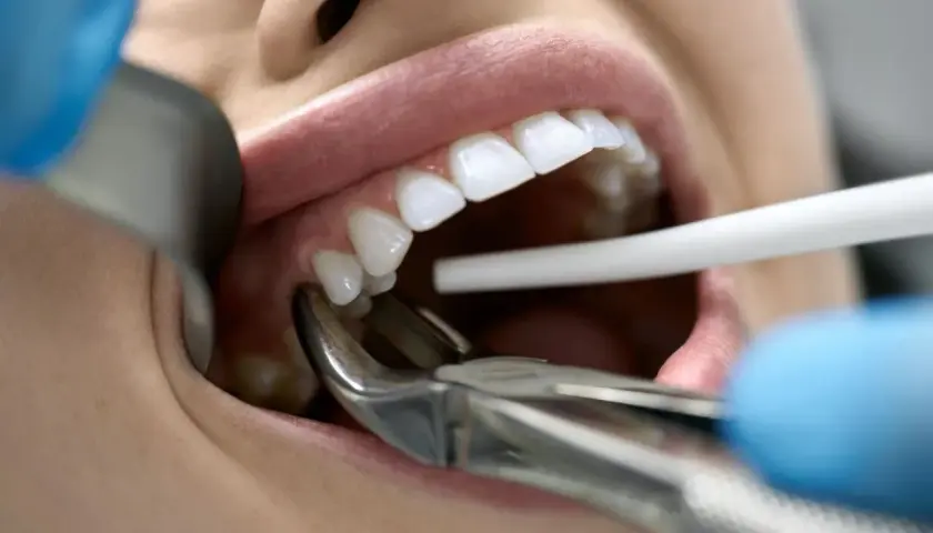 Dentysta usuwa ząb z powodu choroby. Widoczne są kleszcze dentystyczne i białe zęby.