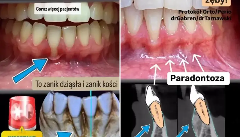 Przed i po: zanik dziąseł i kości (paradontoza) vs. odbudowa kości. Ratujemy zęby!