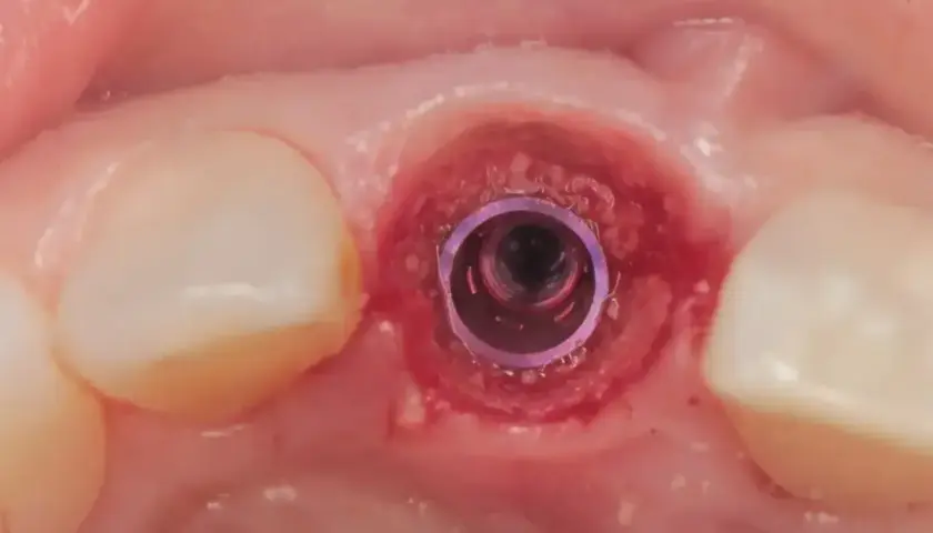 Implant dentystyczny w miejscu po wyrwaniu zęba. Po zabiegu może wystąpić gorączka po wyrwaniu zęba, ale implantacja jest bezpieczna.