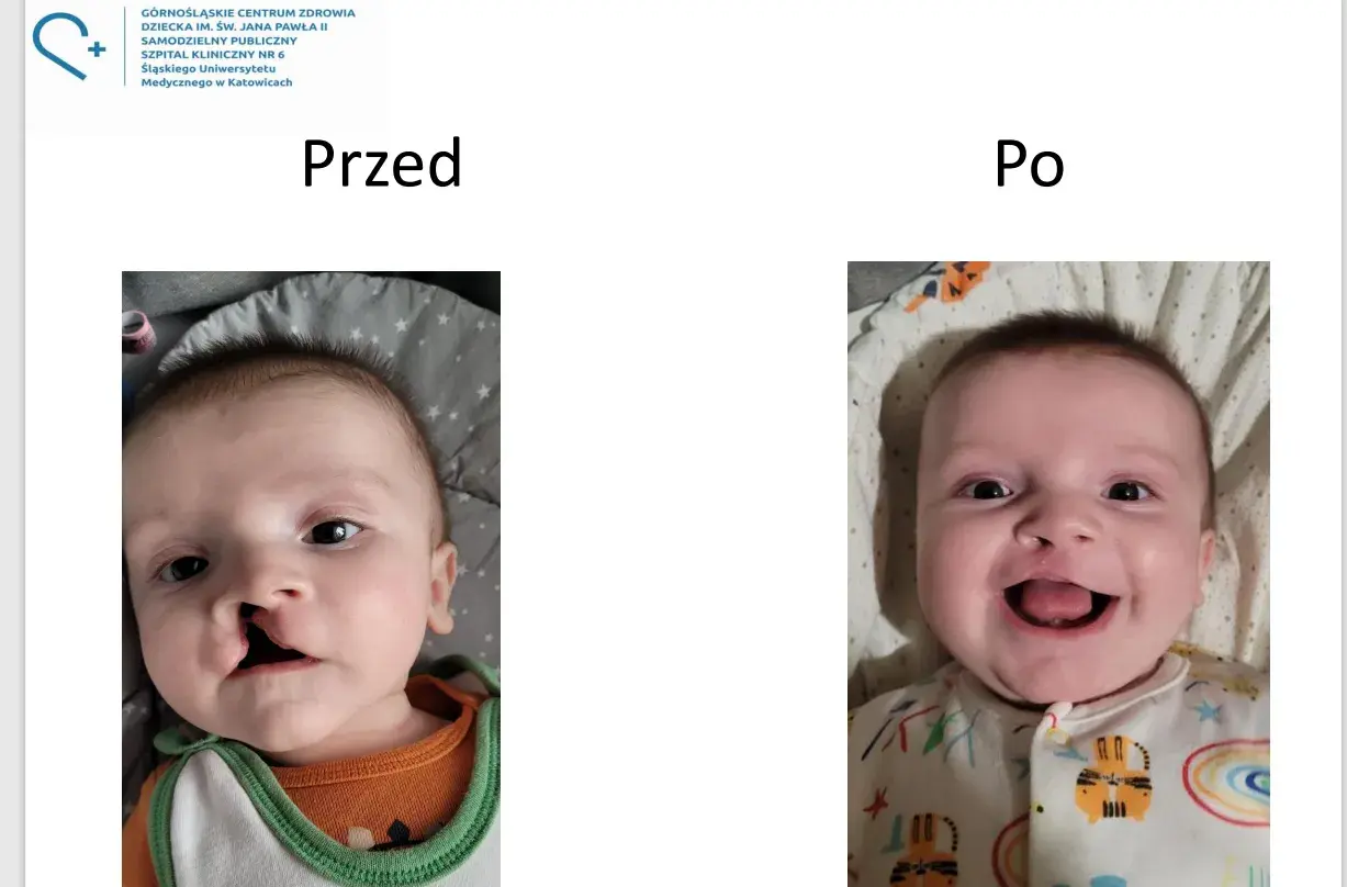 Dziecko z zajęczą wargą przed i po operacji. Uśmiechnięta buzia po korekcie.