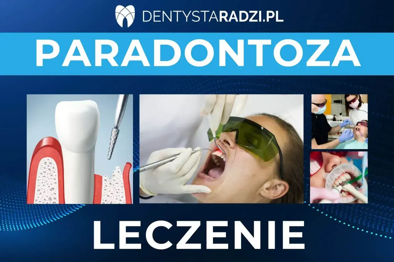 Ilustracje pokazują leczenie paradontozy: przekrój zęba z ubytkami, zabieg laserowy i stomatologiczne szynowanie zębów.