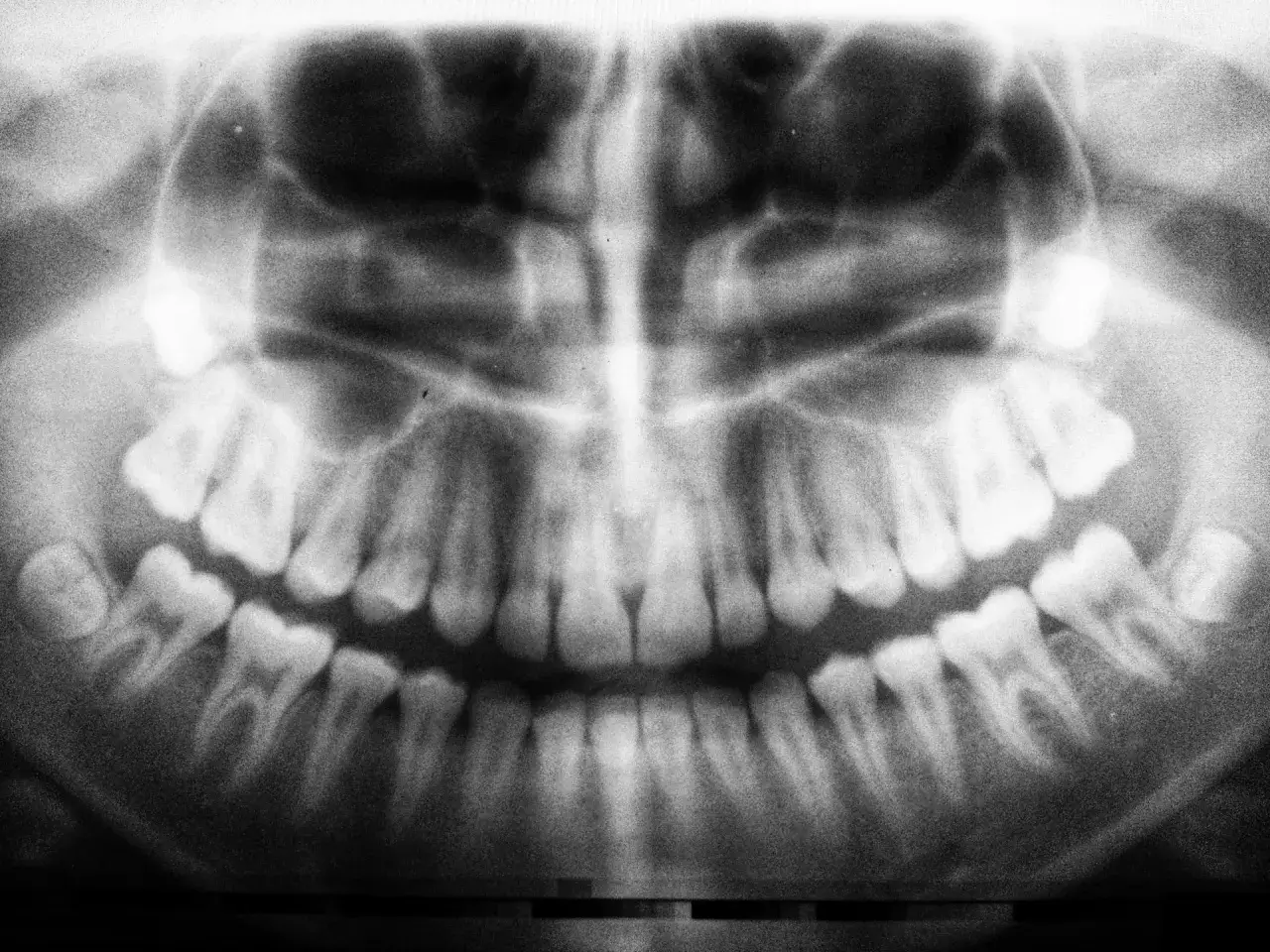Zdjęcie pantomograficzne zębów. Widoczne są korony i korzenie zębów, a także kości szczęki i żuchwy. Może pomóc w diagnozie zaniku kości zęba objawy.