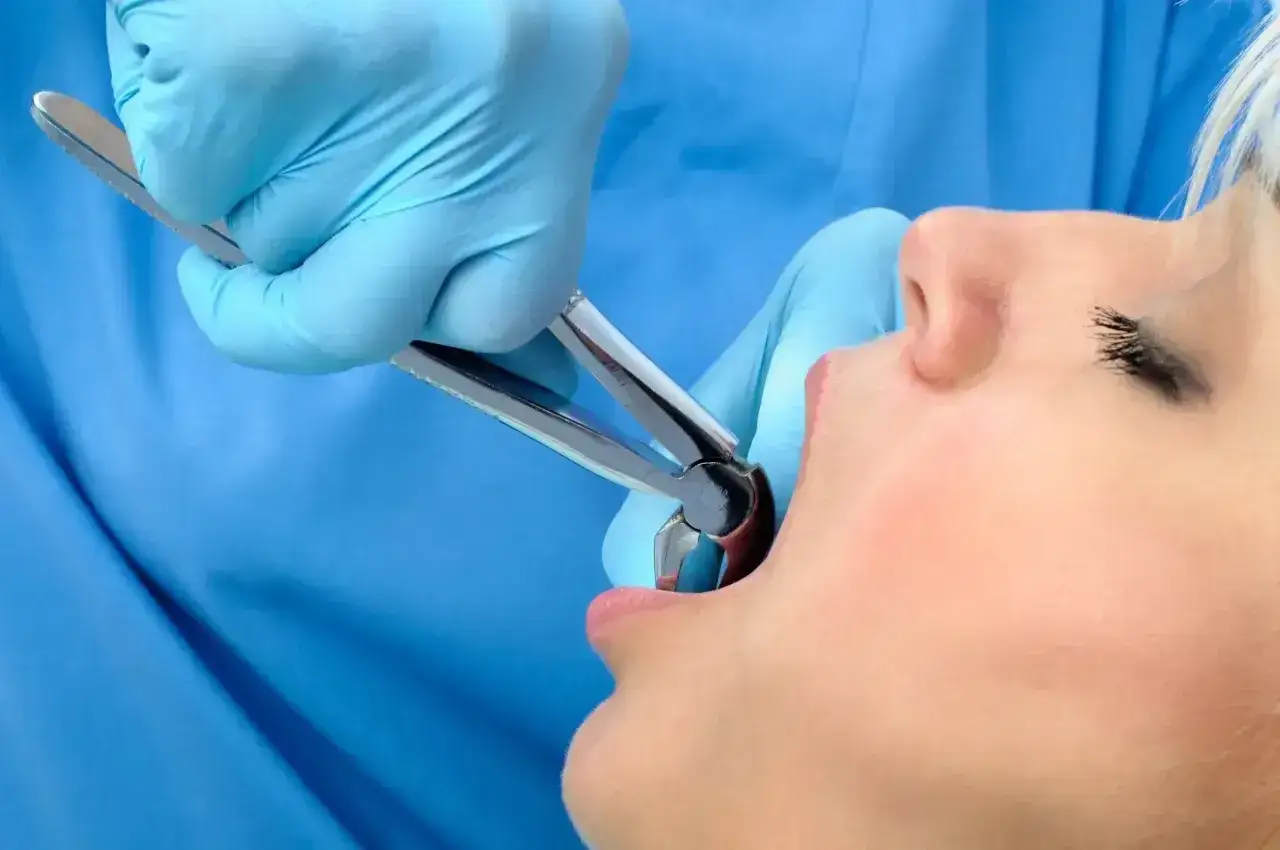 Dentysta w niebieskich rękawiczkach używa kleszczy do ekstrakcji zęba. Pacjentka z otwartymi ustami czeka na moment, kiedy kawa po wyrwaniu zęba będzie już tylko wspomnieniem.