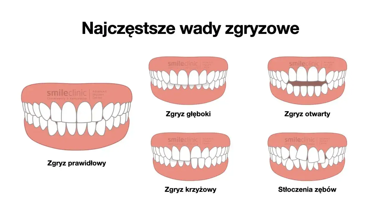 Ilustracja pokazuje różne wady zgryzu, w tym zgryz krzyżowy, gdzie zęby nie są idealnie dopasowane.